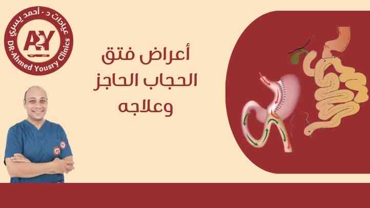 أعراض فتق الحجاب الحاجز وعلاجه
