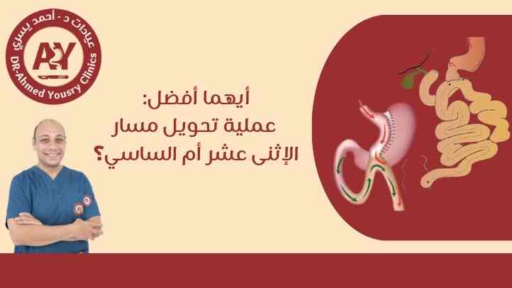 أيهما أفضل: عملية تحويل مسار الإثنى عشر أم الساسي؟