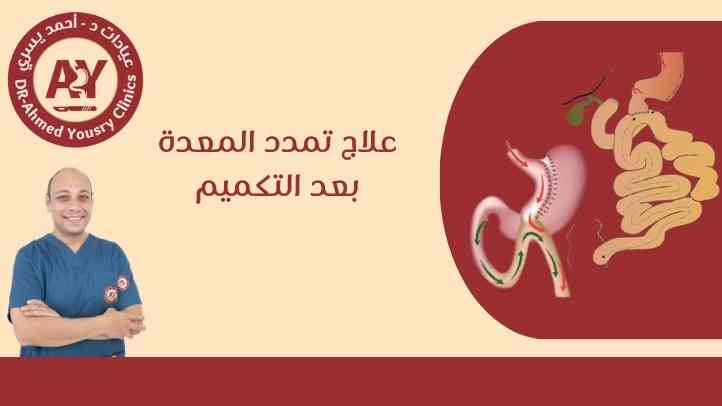 علاج تمدد المعدة بعد التكميم